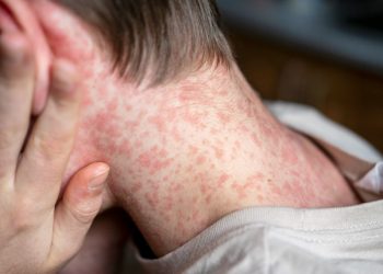 Waspada Campak, Penyakit Menular Tinggi yang Masih Mengancam