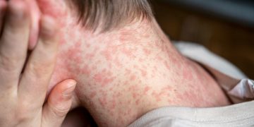 Waspada Campak, Penyakit Menular Tinggi yang Masih Mengancam